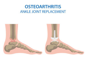 ankle joint replacement treatment osteoarthiritis