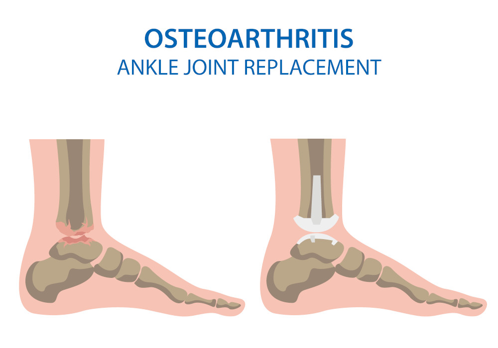 Ankle Joint Replacement Arthroplasty Are you a candidate?
