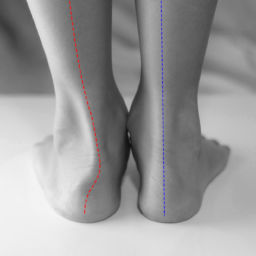 flat foot reconstruction surgery