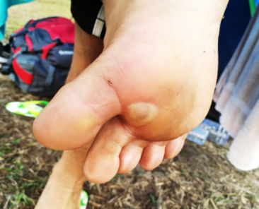 blister under the foot