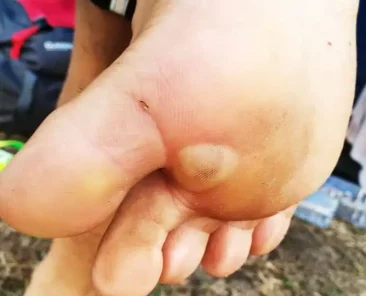 blister under the foot