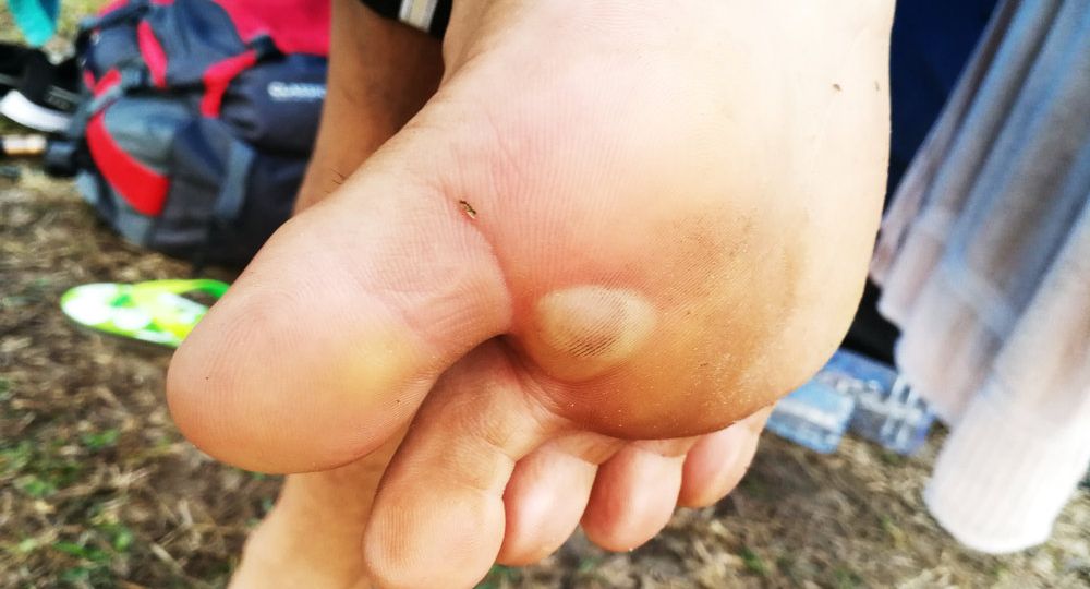 White blister on heel sale of foot