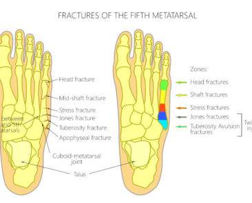 types of foot fractures metatarsal