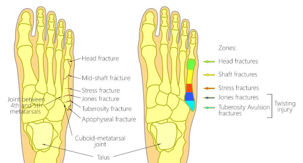 types of foot fractures metatarsal