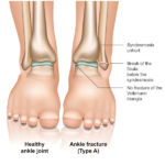 There are different types of foot fractures, learn how to identify each