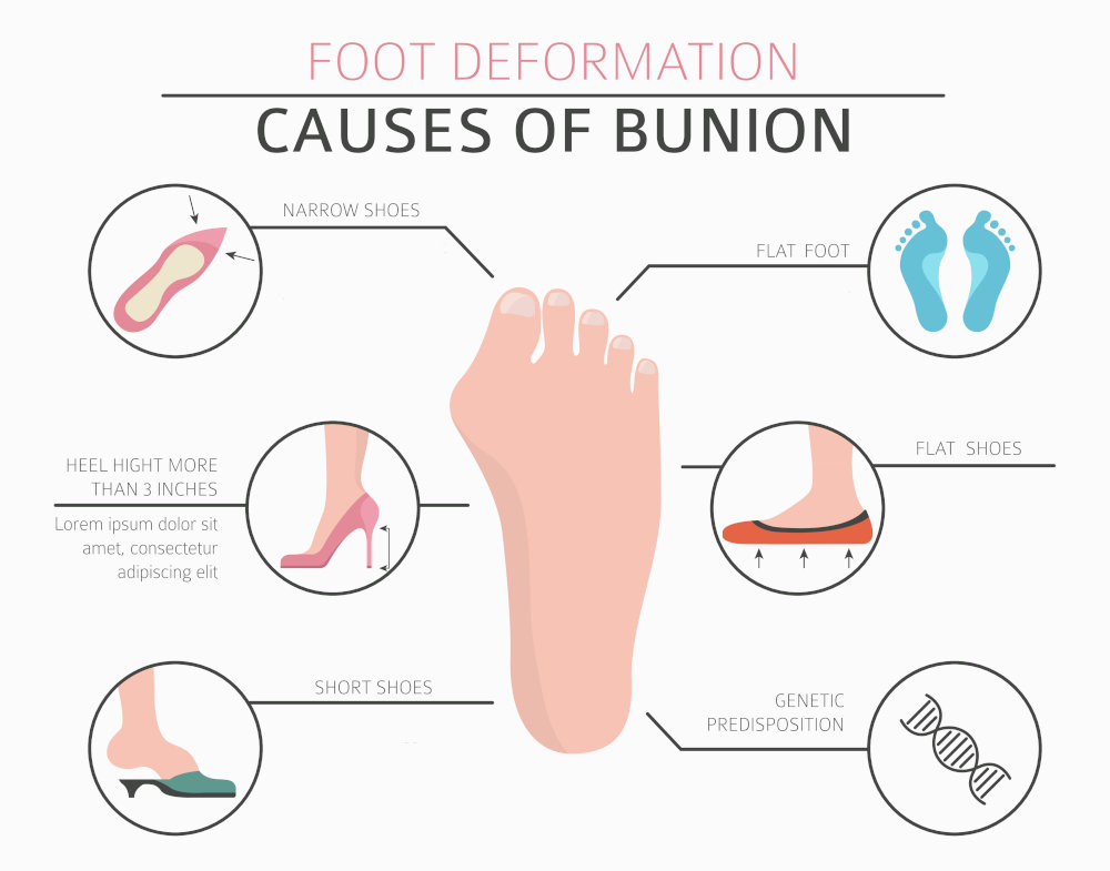 Bunion Foot Deformation