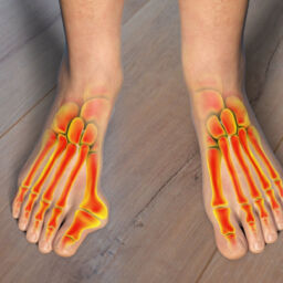 bunions treatment without surgery