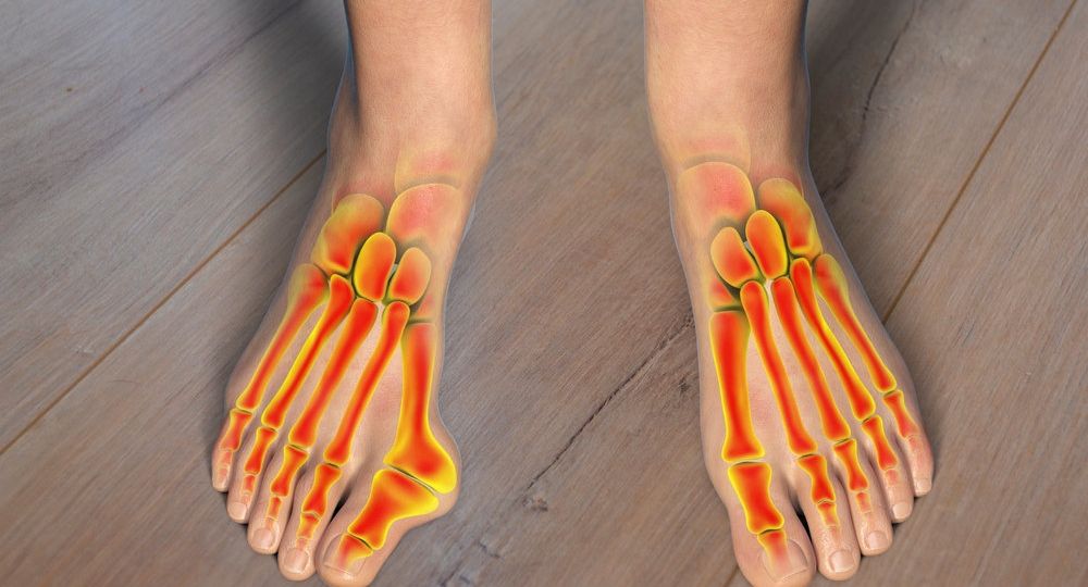 bunions treatment without surgery
