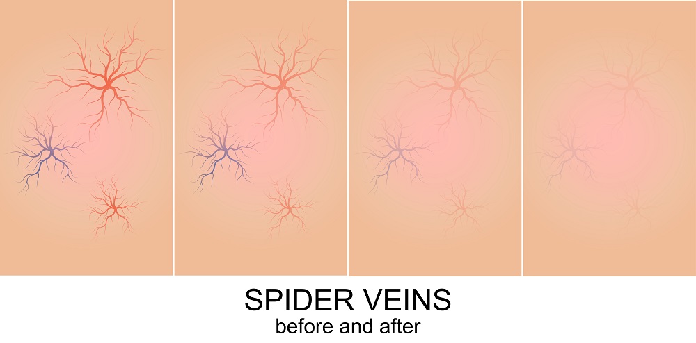 spider veins before after treatment infographic