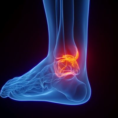 posterior ankle impingement-syndrome