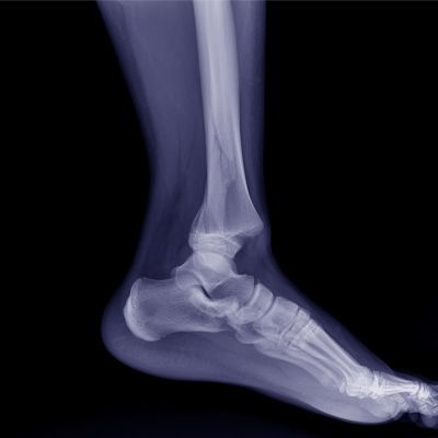 tarsal sinus syndrome