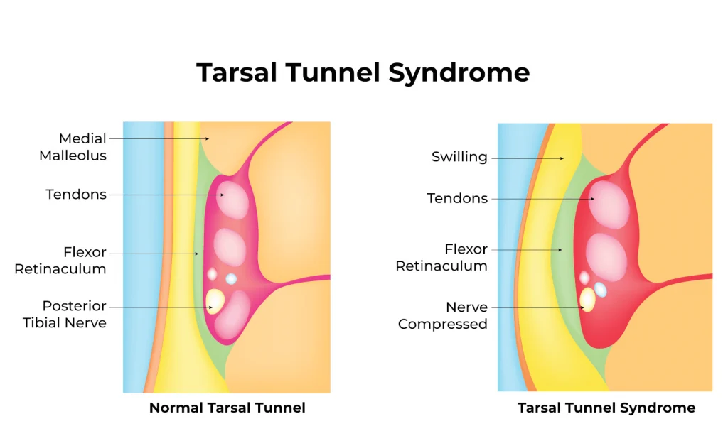 Tarsal Sinus Syndrome sinus tarsi Infographic