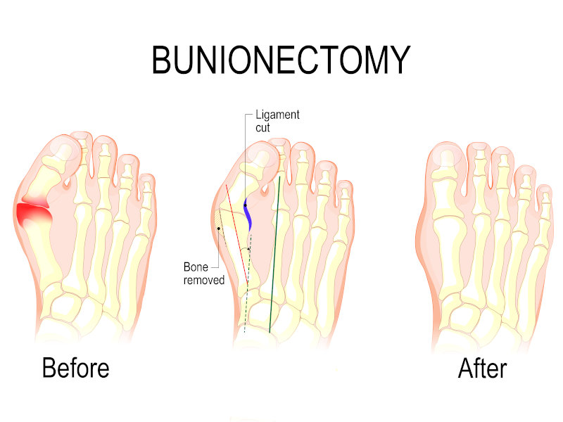 bunion-minimally-invasive-surgery-before-after