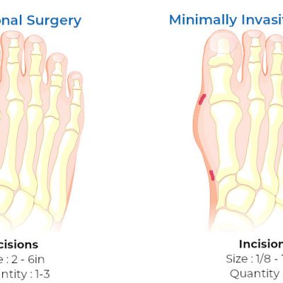 minimally invasive bunion surgery