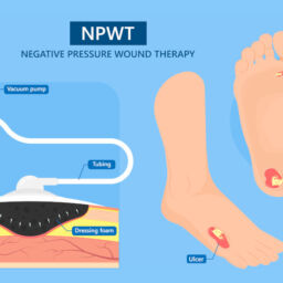 negative pressure wound therapy