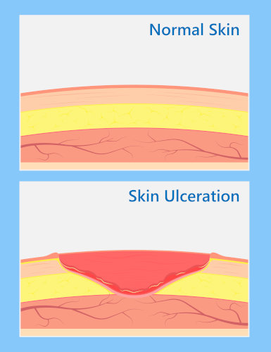 normal skin versus skin ulceration negative wound theraphy