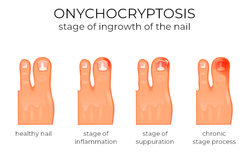 onychocryptosis ingrown toenail stages of pain