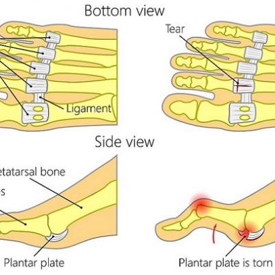 plantar plate tear