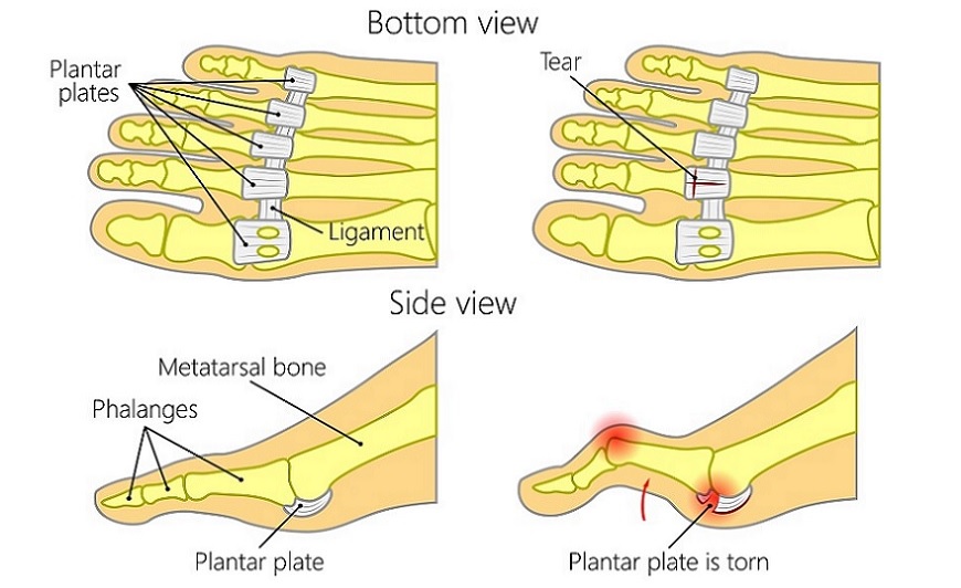 Plantar Plate Tear Causes Symptoms And Treatment