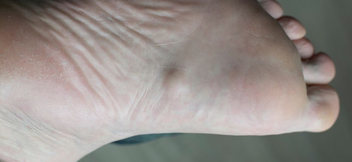 plantar fibroma treatment