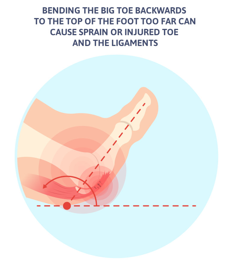 ligament angel of turf toe treatment info graphic