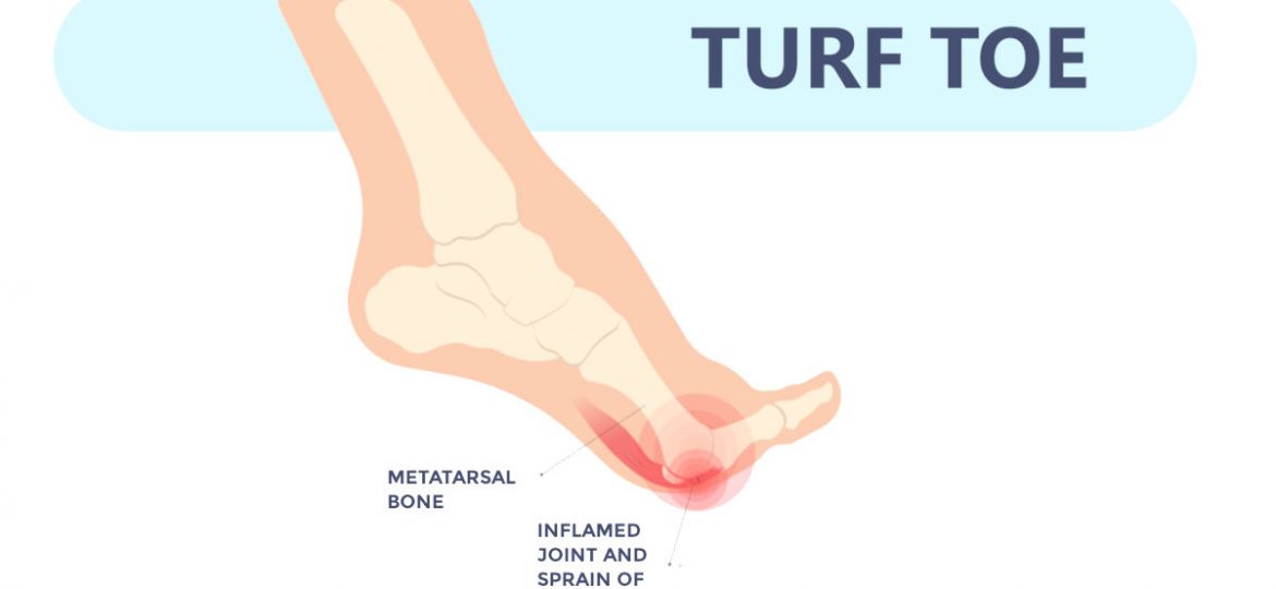 Turf toe treatment to reduce the inflammation and stop the pain!