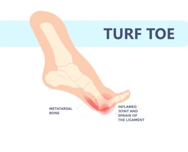 turf toe treatment