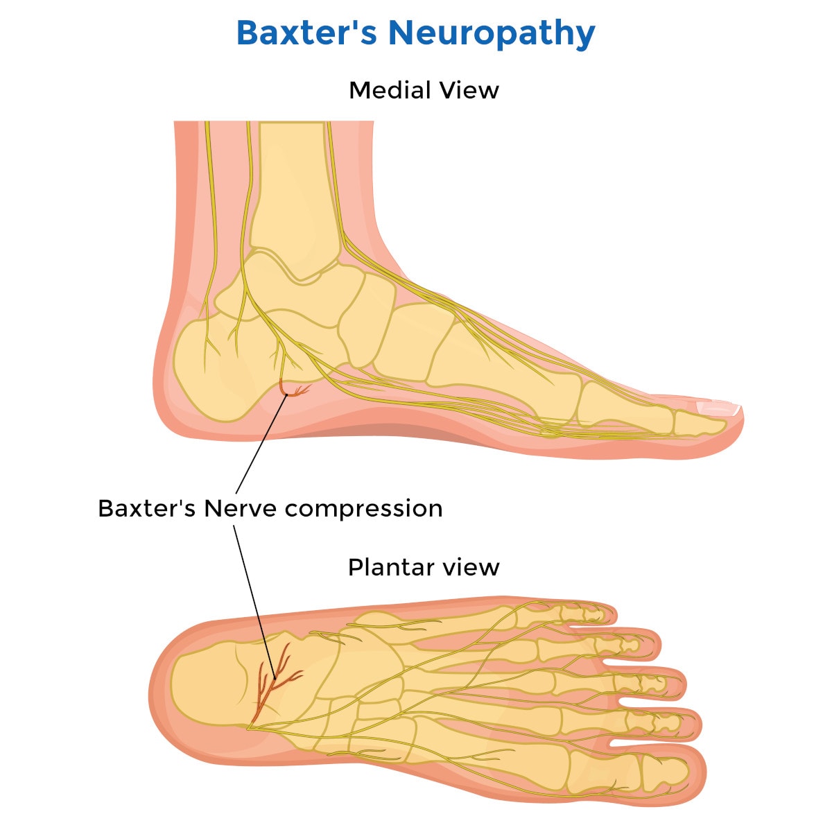 baxter’s nerve entrapment inofgraphic nerve