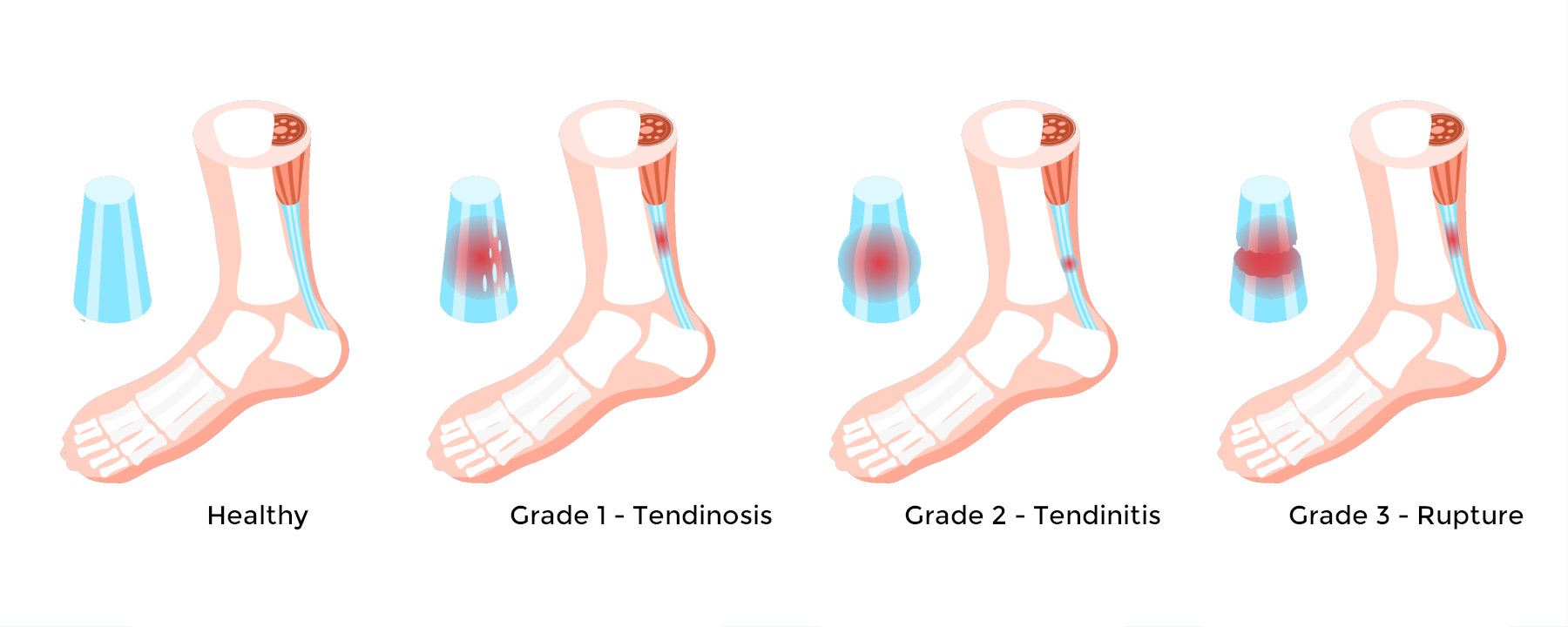 Achilles tendon grades infographic