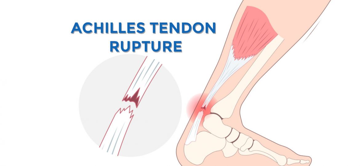 achilles tendon rupture