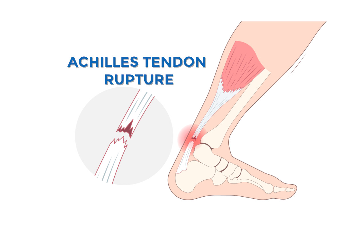 Achilles Tendon Rupture Empower Your Recovery 