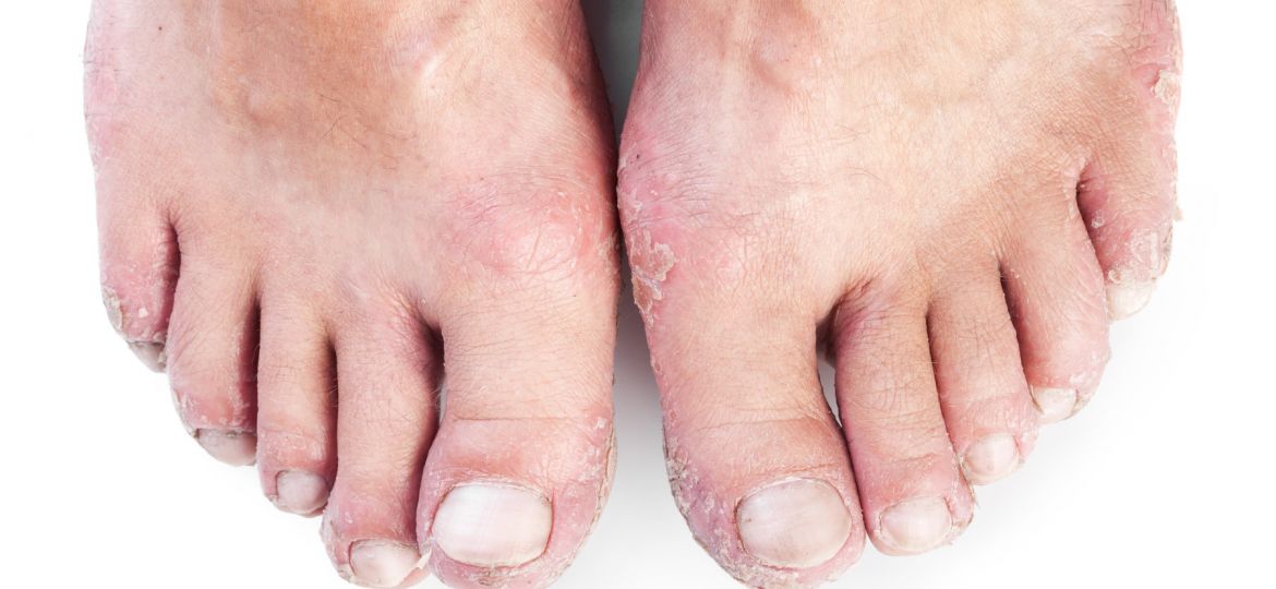 eczema on feet