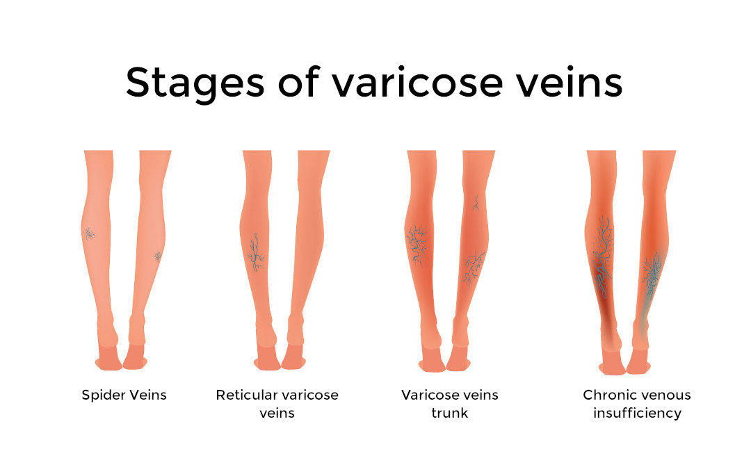 stages varicose veins progression infographic