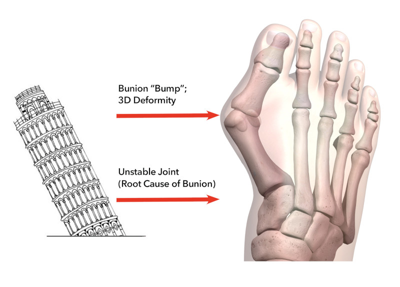 Lapiplasty before correction bones 3D Bunion