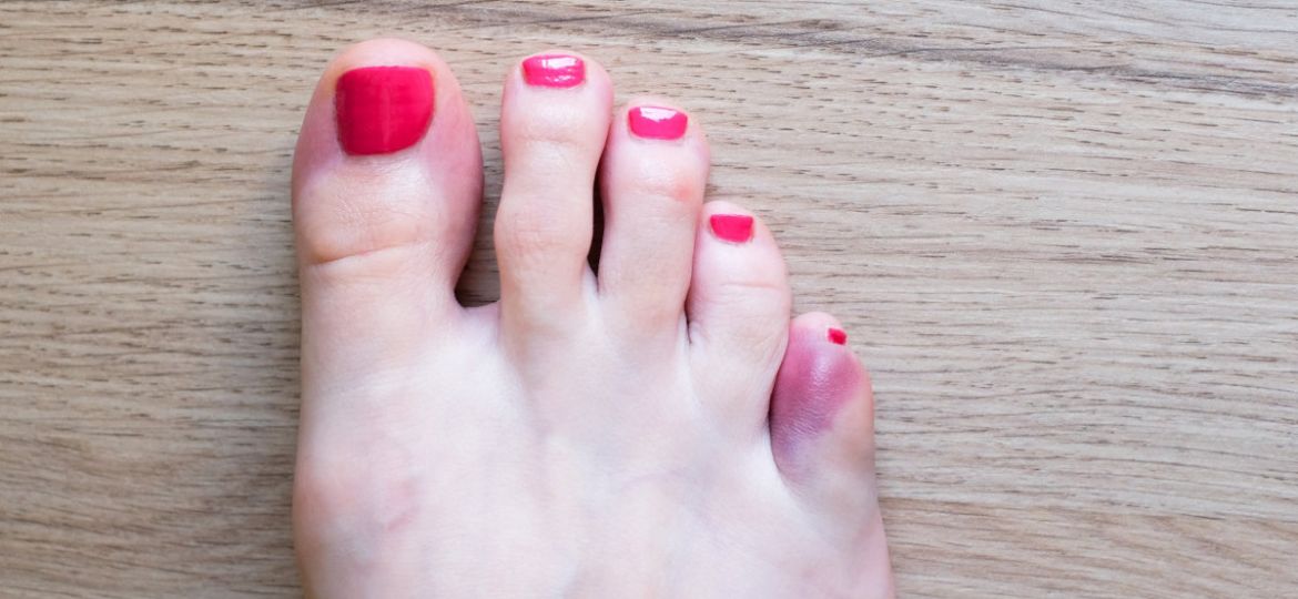 broken pinky toe