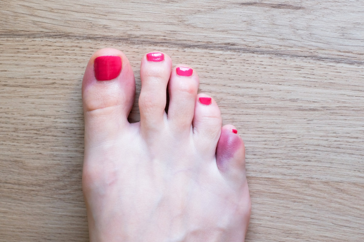 Broken Pinky Toe Treatment: Effective Methods for Quick Healing