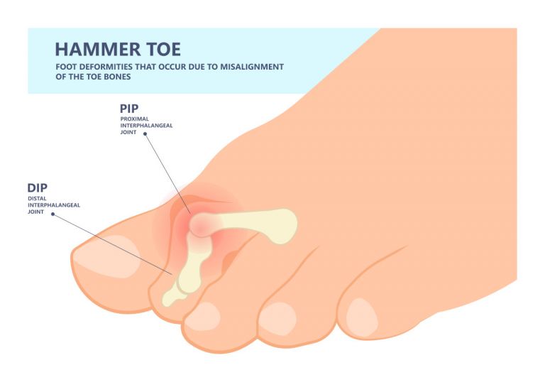 Hammer Toe Treatment Secrets: What You Need to Know