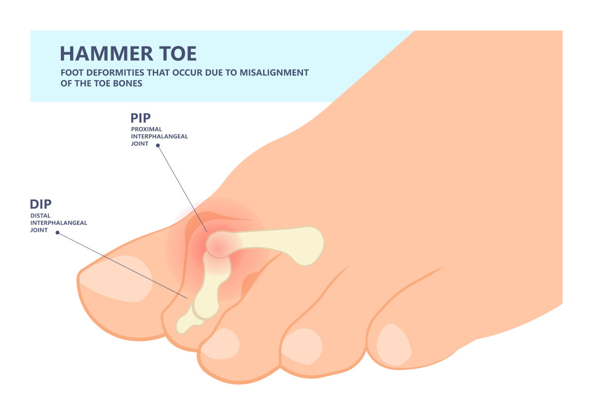 hammer toe treatment infographic
