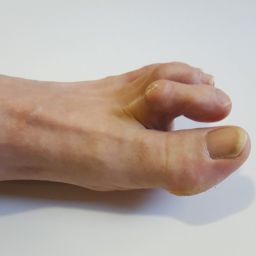 hammer toe treatment certifiedfoot and ankle specialists