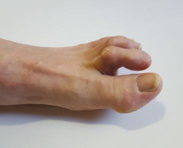 hammer toe treatment certifiedfoot and ankle specialists