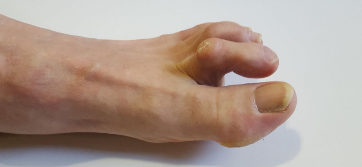 hammer toe treatment certifiedfoot and ankle specialists