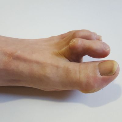 hammer toe treatment certifiedfoot and ankle specialists