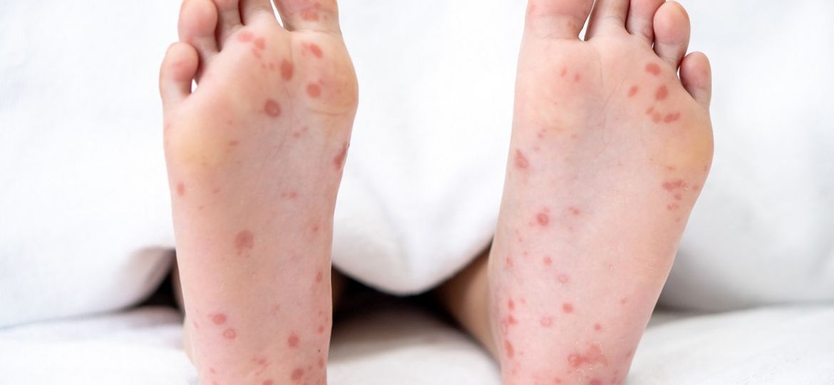 red spots on feet