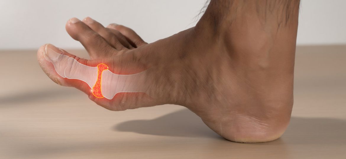 arthritis in big toe joint