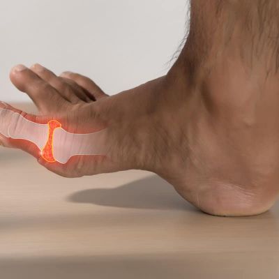 arthritis in big toe joint