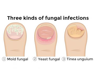 types of nail fungus