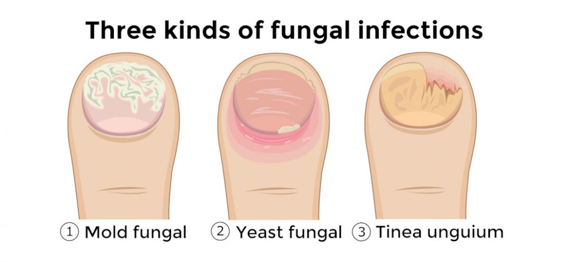 types of nail fungus