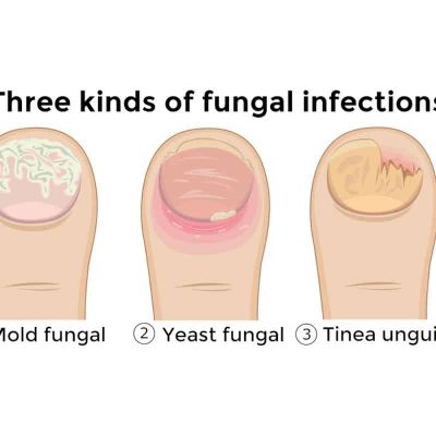 types of nail fungus