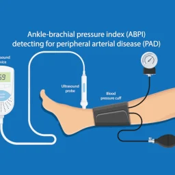 ankle brachial index test