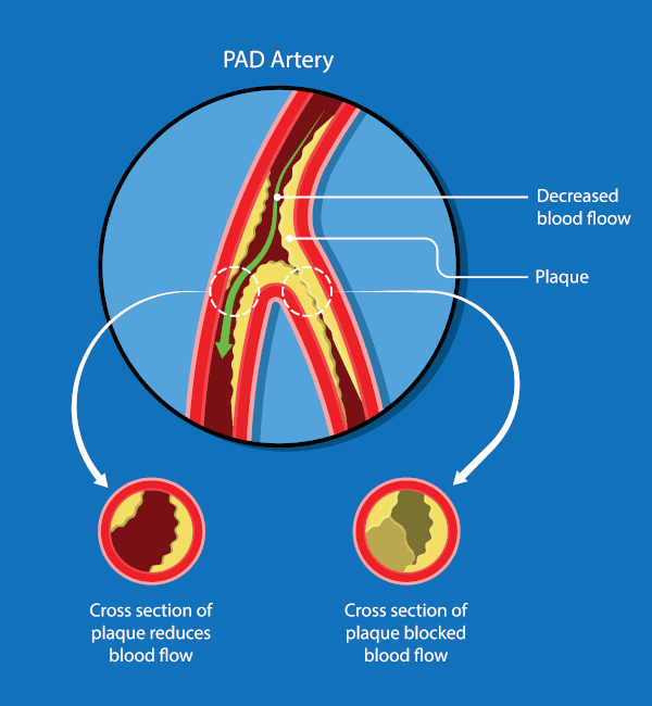 ankle brachial index artery disease infographic